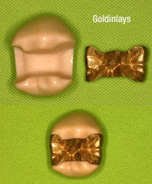 Zahnarzt, Zahnerhaltung, Goldinlay